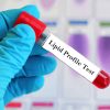 Lipid Profile Test